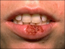How Do You Treat Herpes Simplex : Penis Rash Symptoms  6 Conditions That Affect The Penis Skin